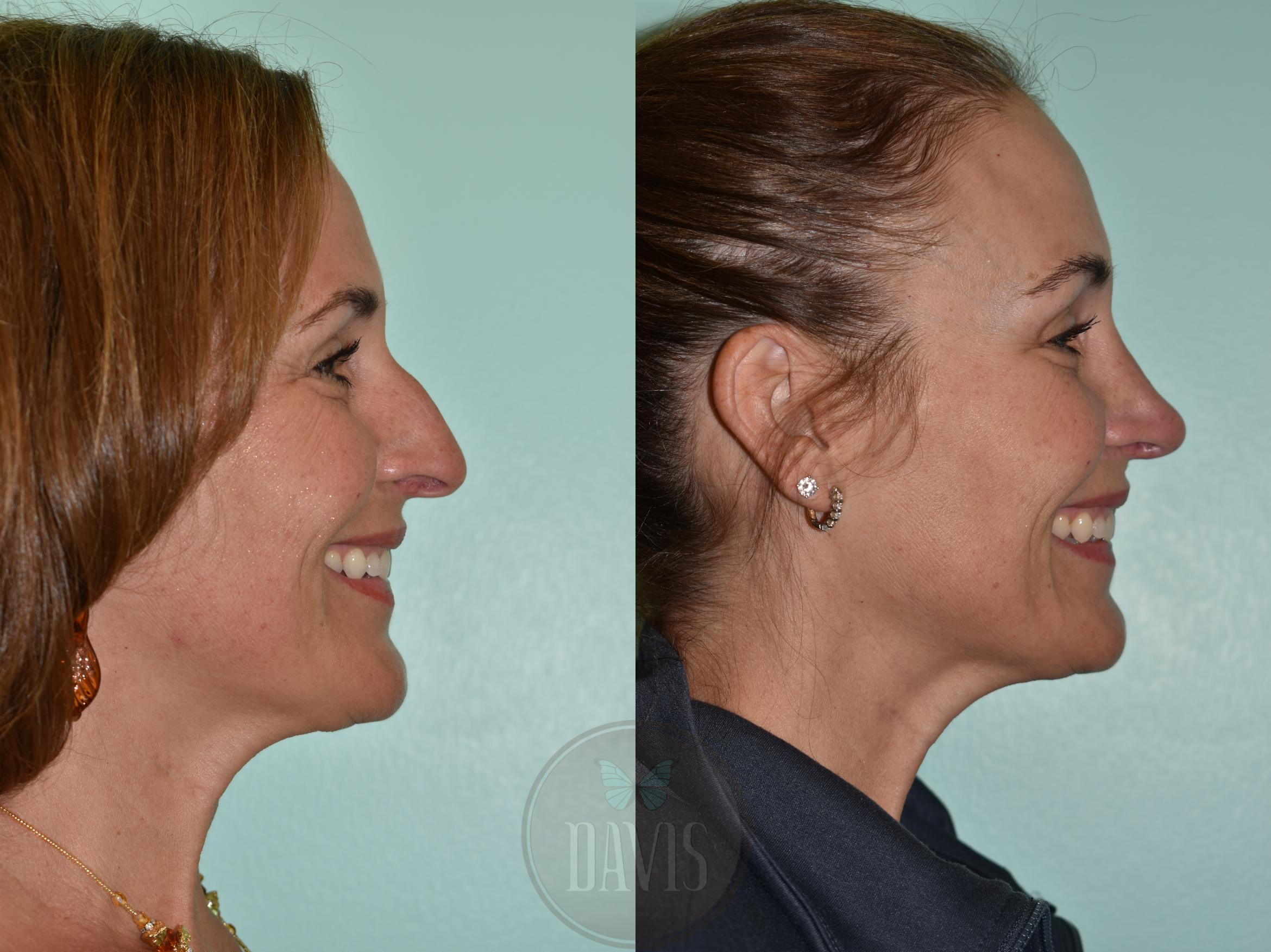Before & After Female Rhinoplasty Case 1155 Right Side View in Tampa, FL
