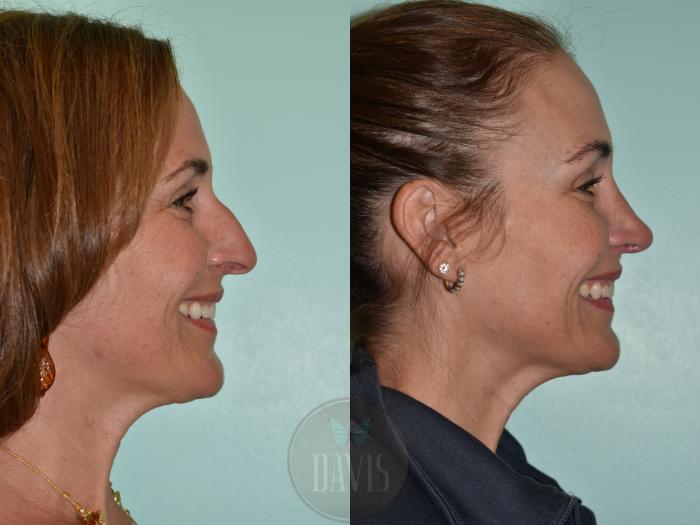 Before & After Female Rhinoplasty Case 1155 Right Side View in Tampa, FL