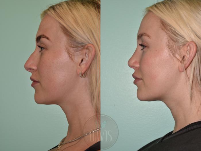 Before & After Female Rhinoplasty Case 1156 Front View in Tampa, FL