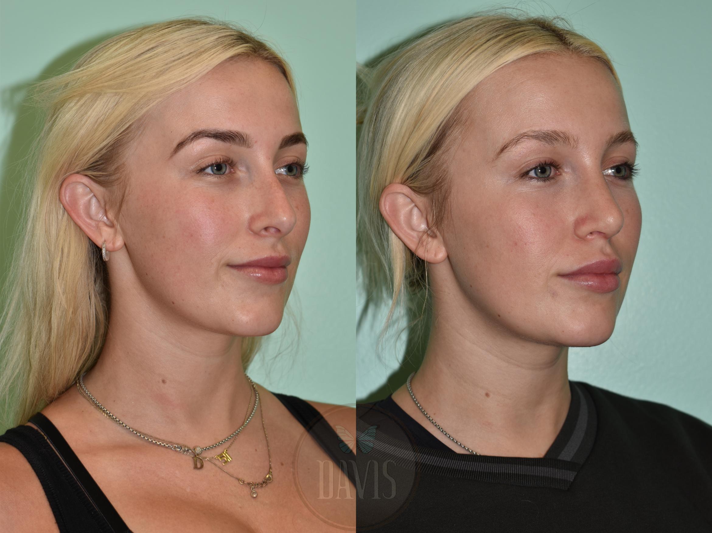 Before & After Female Rhinoplasty Case 1156 Left Oblique View in Tampa, FL