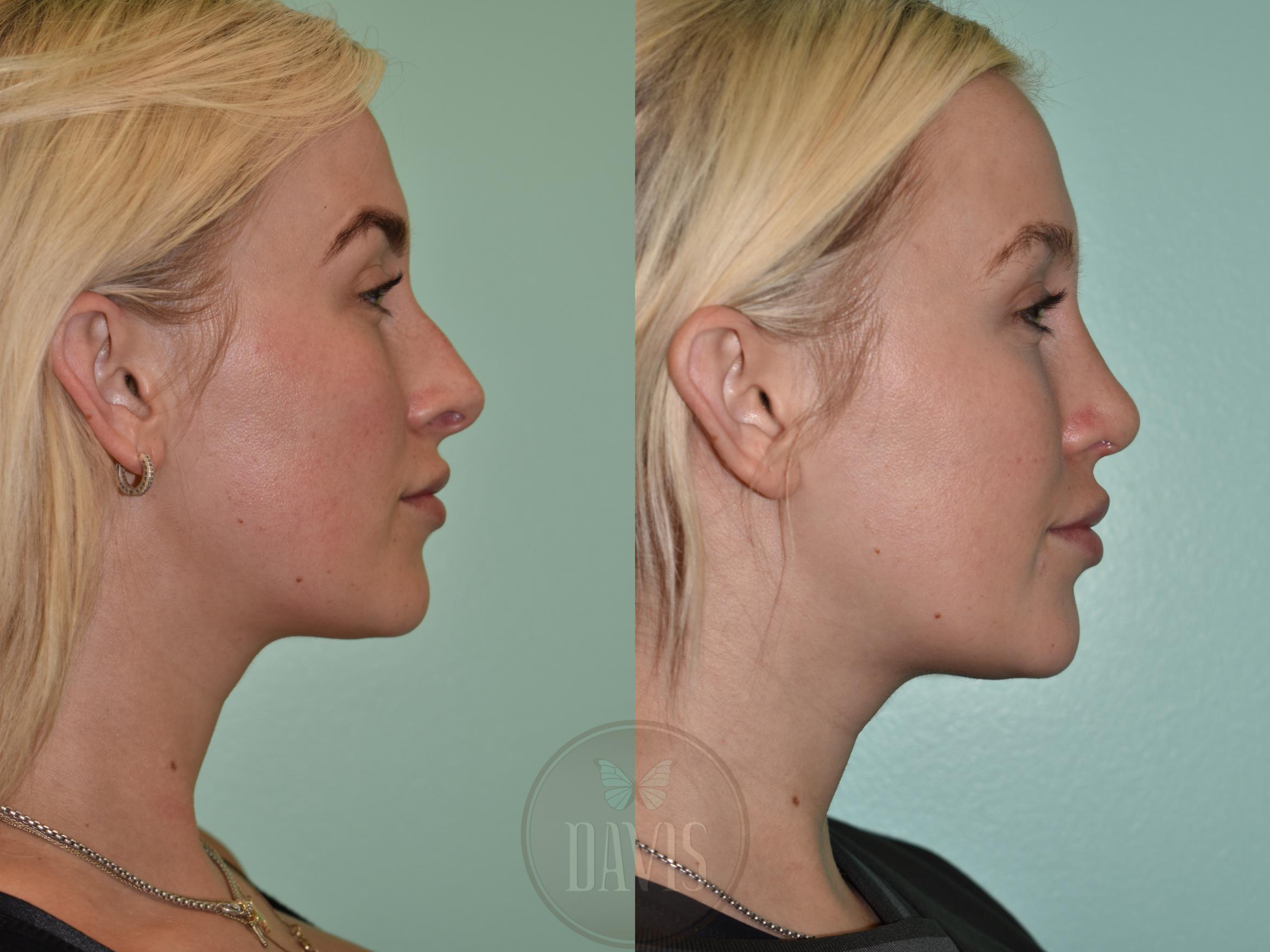 Before & After Female Rhinoplasty Case 1156 Left Side View in Tampa, FL