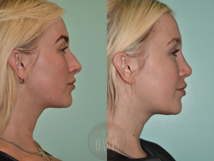 Before & After Female Rhinoplasty Case 1156 Left Side View in Tampa, FL