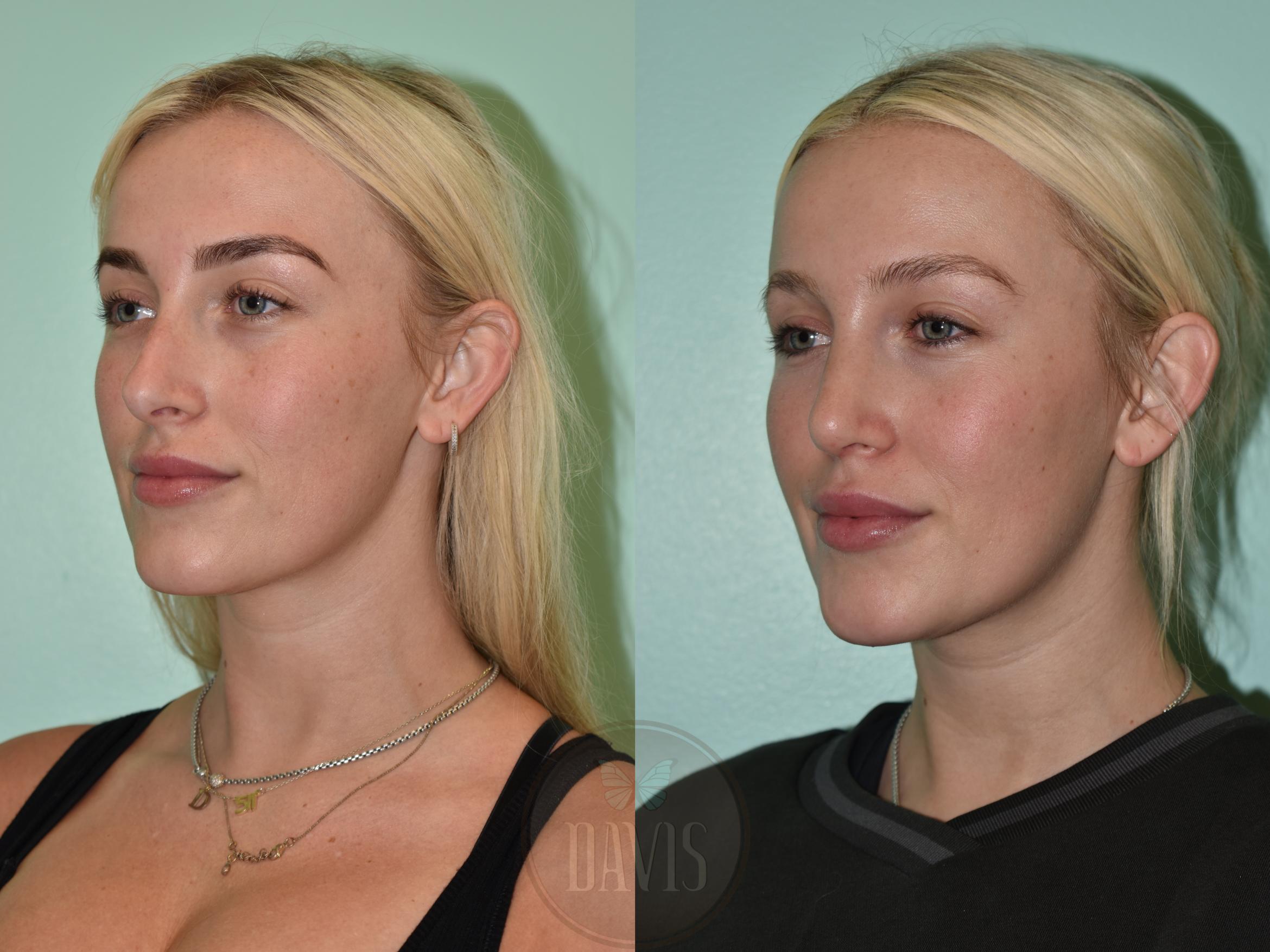 Before & After Female Rhinoplasty Case 1156 Right Side View in Tampa, FL