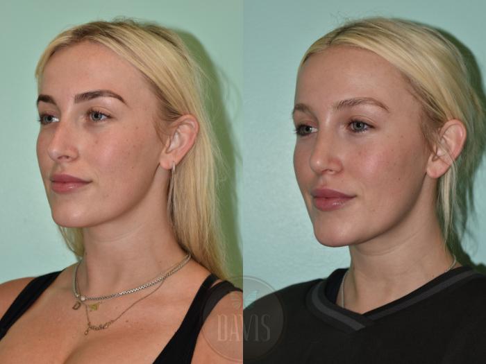 Before & After Female Rhinoplasty Case 1156 Right Side View in Tampa, FL