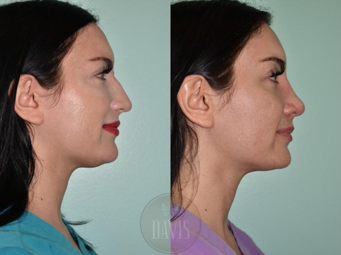 Before & After Female Rhinoplasty Case 1157 Front View in Tampa, FL