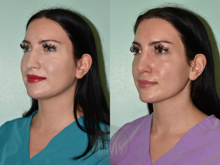 Before & After Female Rhinoplasty Case 1157 Left Oblique View in Tampa, FL