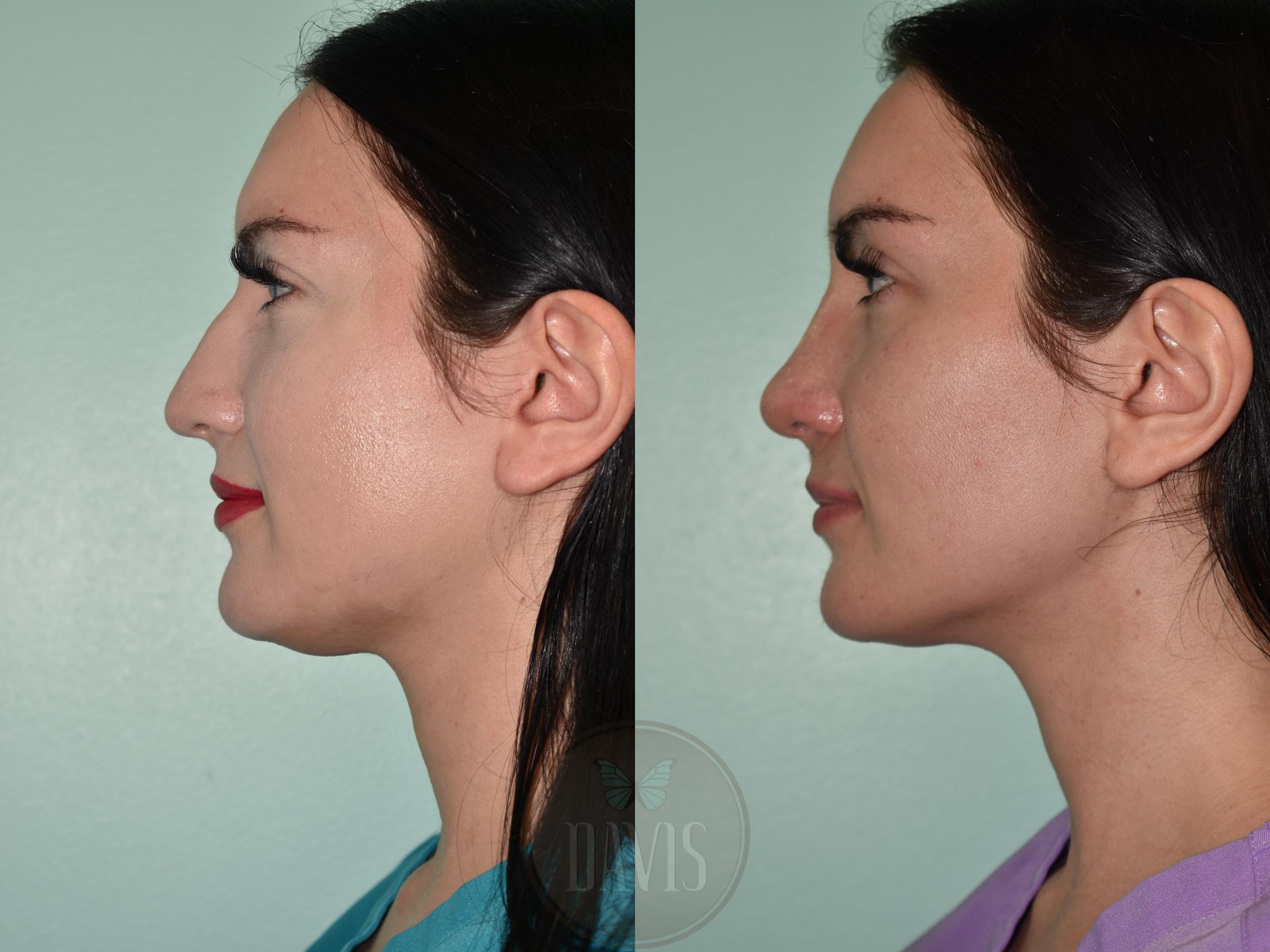 Before & After Female Rhinoplasty Case 1157 Left Side View in Tampa, FL
