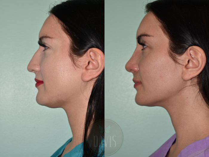 Before & After Female Rhinoplasty Case 1157 Left Side View in Tampa, FL