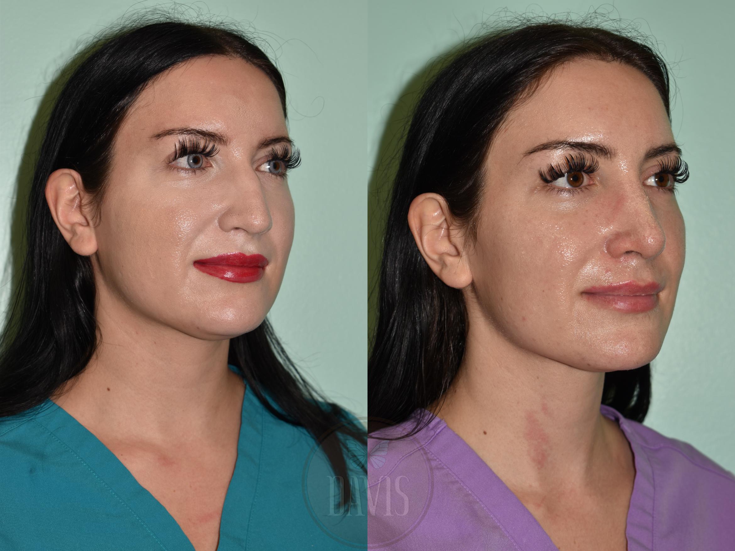 Before & After Female Rhinoplasty Case 1157 Right Side View in Tampa, FL