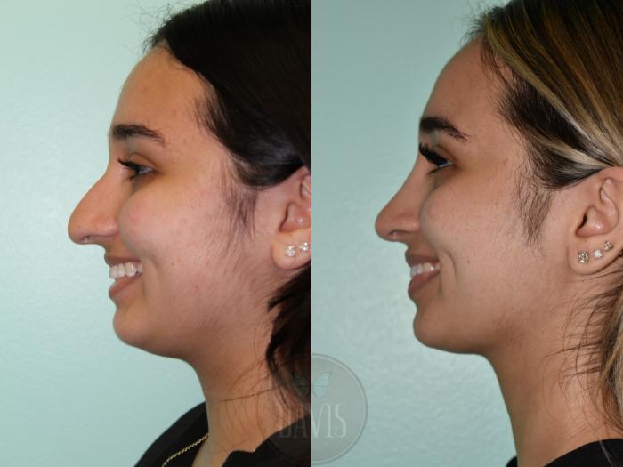 Before & After Female Rhinoplasty Case 1159 Front View in Tampa, FL