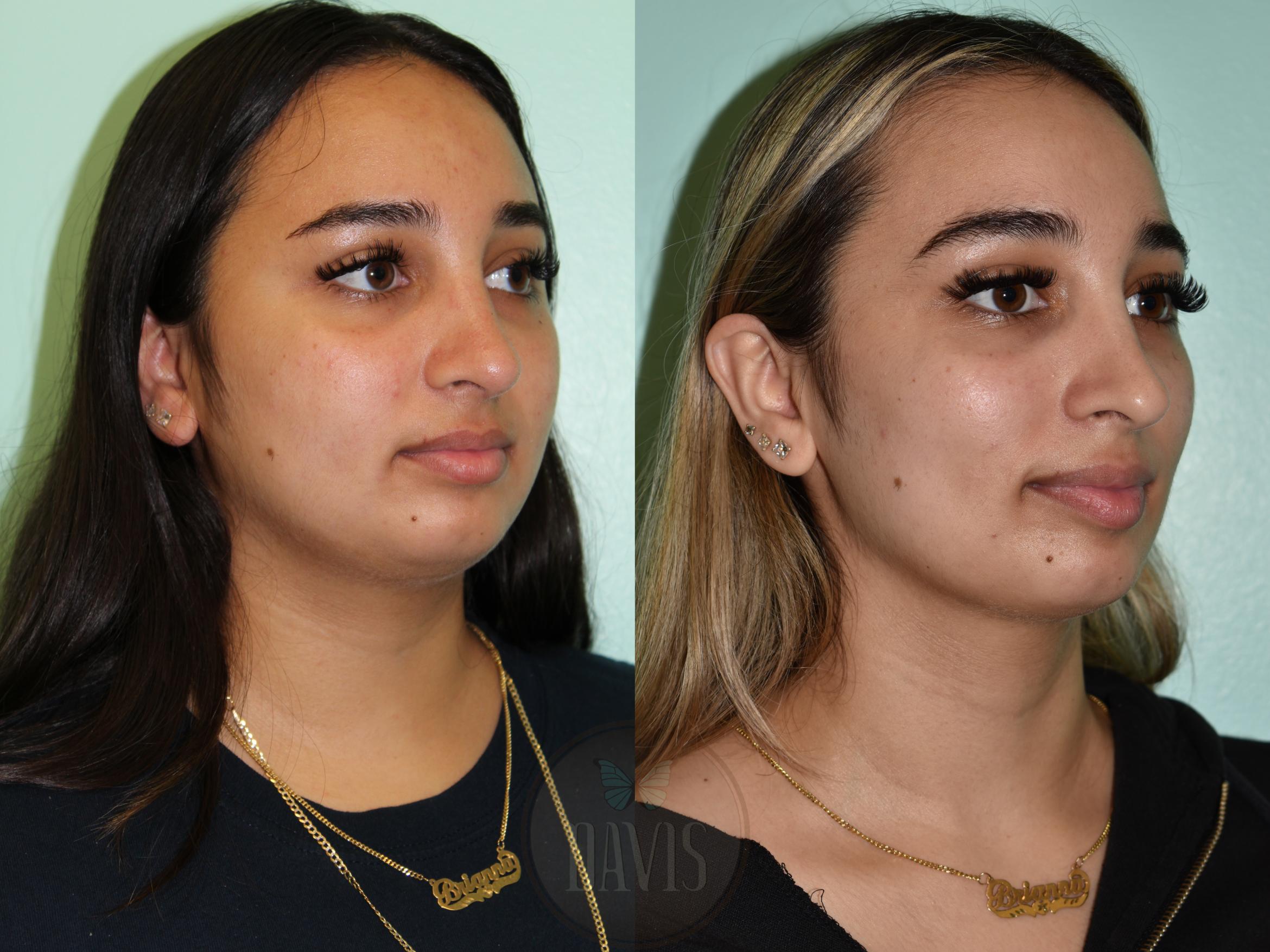 Before & After Female Rhinoplasty Case 1159 Left Oblique View in Tampa, FL
