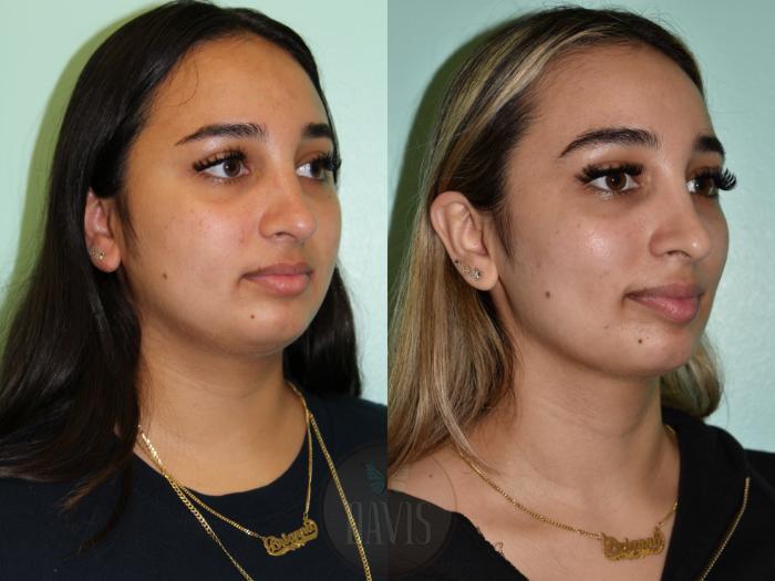 Before & After Female Rhinoplasty Case 1159 Left Oblique View in Tampa, FL