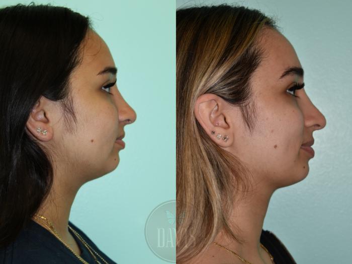 Before & After Female Rhinoplasty Case 1159 Left Side View in Tampa, FL
