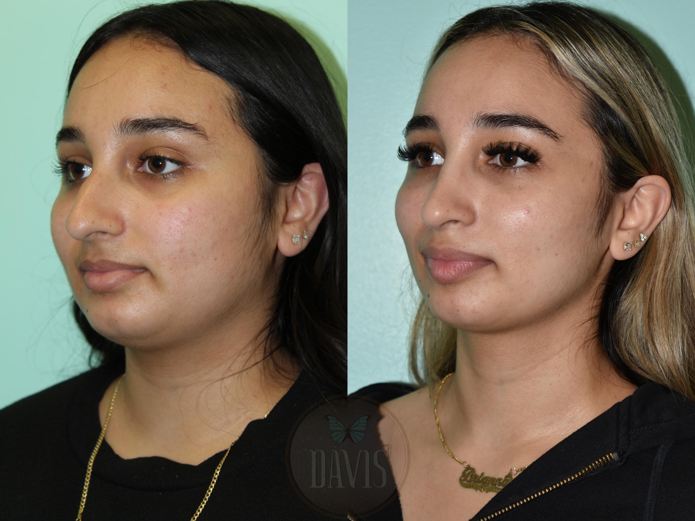 Before & After Female Rhinoplasty Case 1159 Right Side View in Tampa, FL