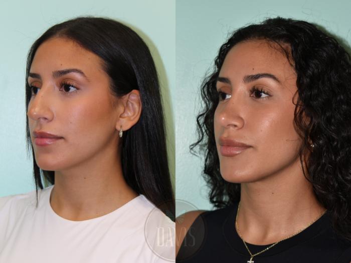 Before & After Female Rhinoplasty Case 1160 Front View in Tampa, FL