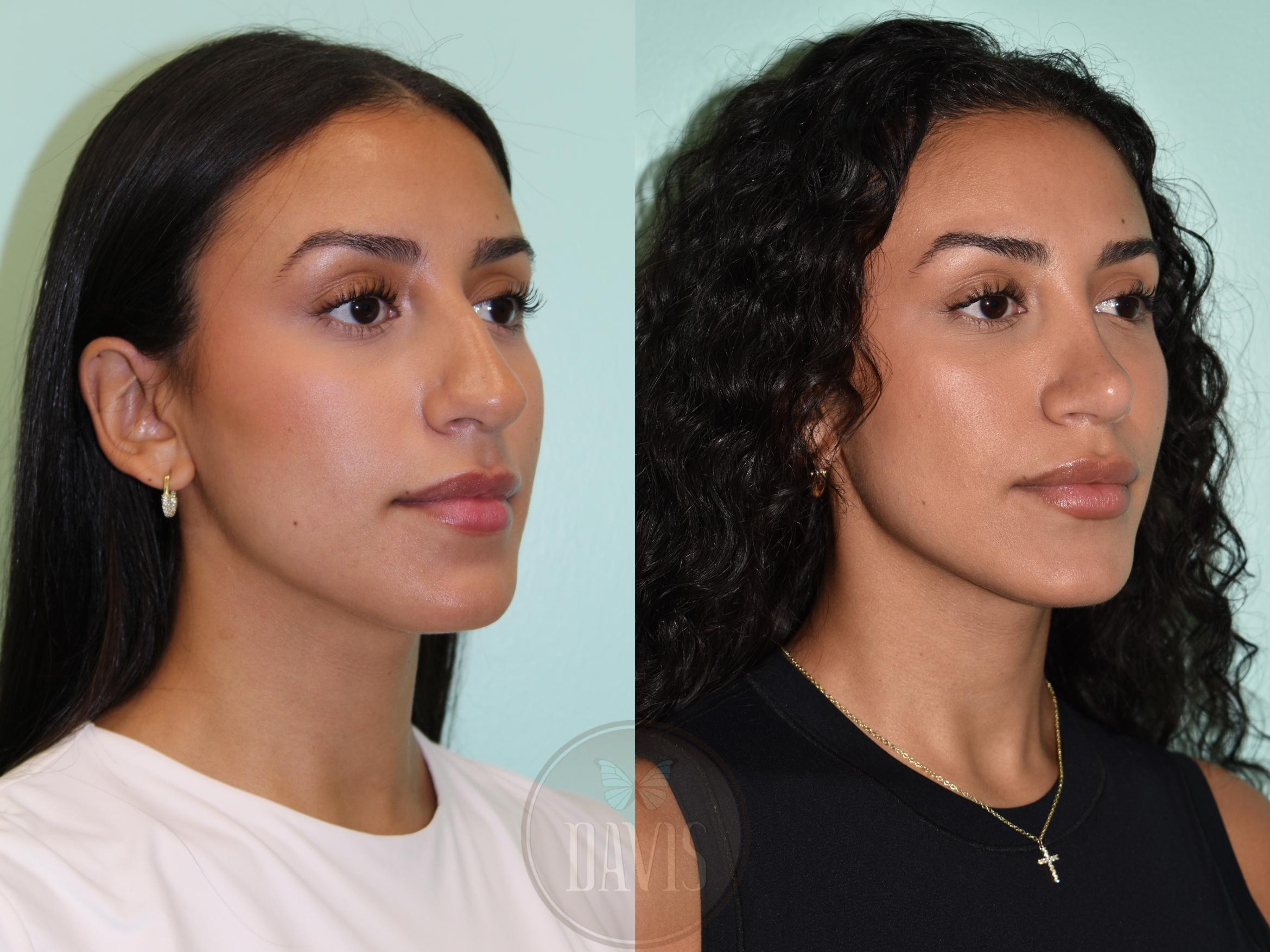 Before & After Female Rhinoplasty Case 1160 Left Oblique View in Tampa, FL