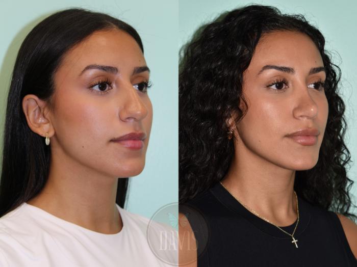 Before & After Female Rhinoplasty Case 1160 Left Oblique View in Tampa, FL