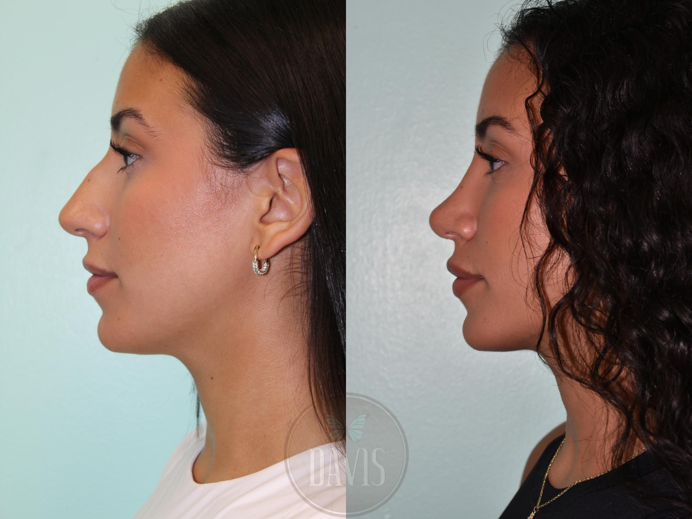 Before & After Female Rhinoplasty Case 1160 Left Side View in Tampa, FL