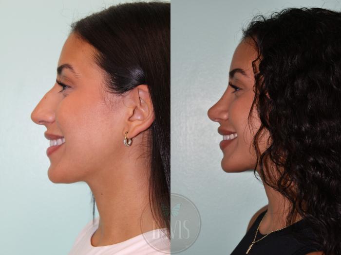 Before & After Female Rhinoplasty Case 1160 Right Side View in Tampa, FL