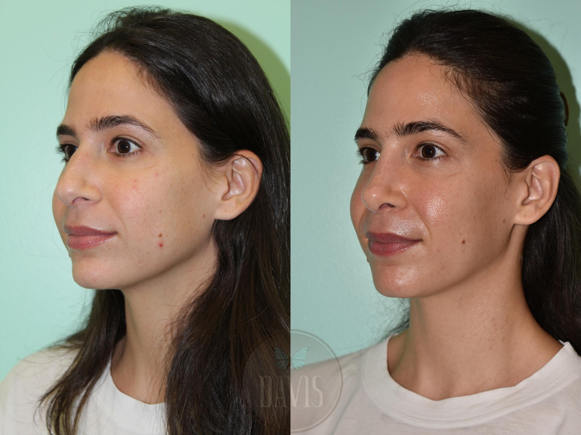 Before & After Female Rhinoplasty Case 1161 Left Oblique View in Tampa, FL