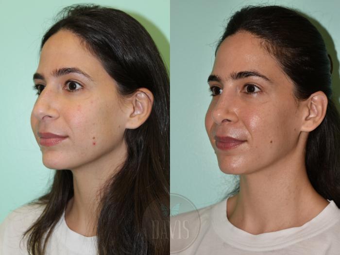 Before & After Female Rhinoplasty Case 1161 Left Oblique View in Tampa, FL