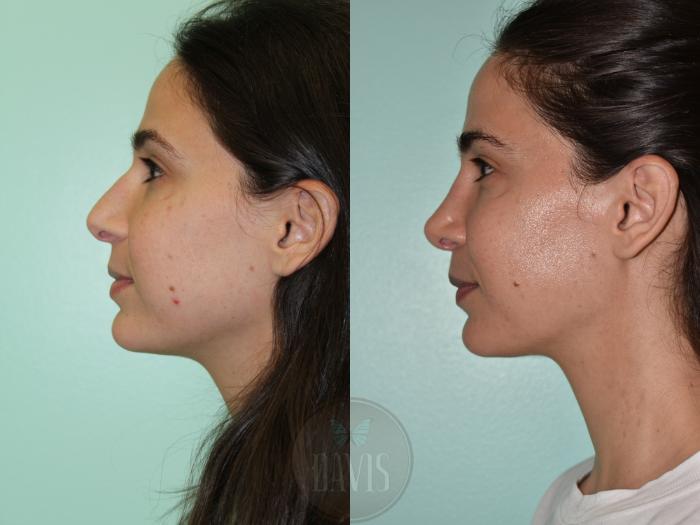 Before & After Female Rhinoplasty Case 1161 Left Side View in Tampa, FL