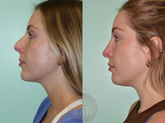 Before & After Female Rhinoplasty Case 1165 Left Oblique View in Tampa, FL