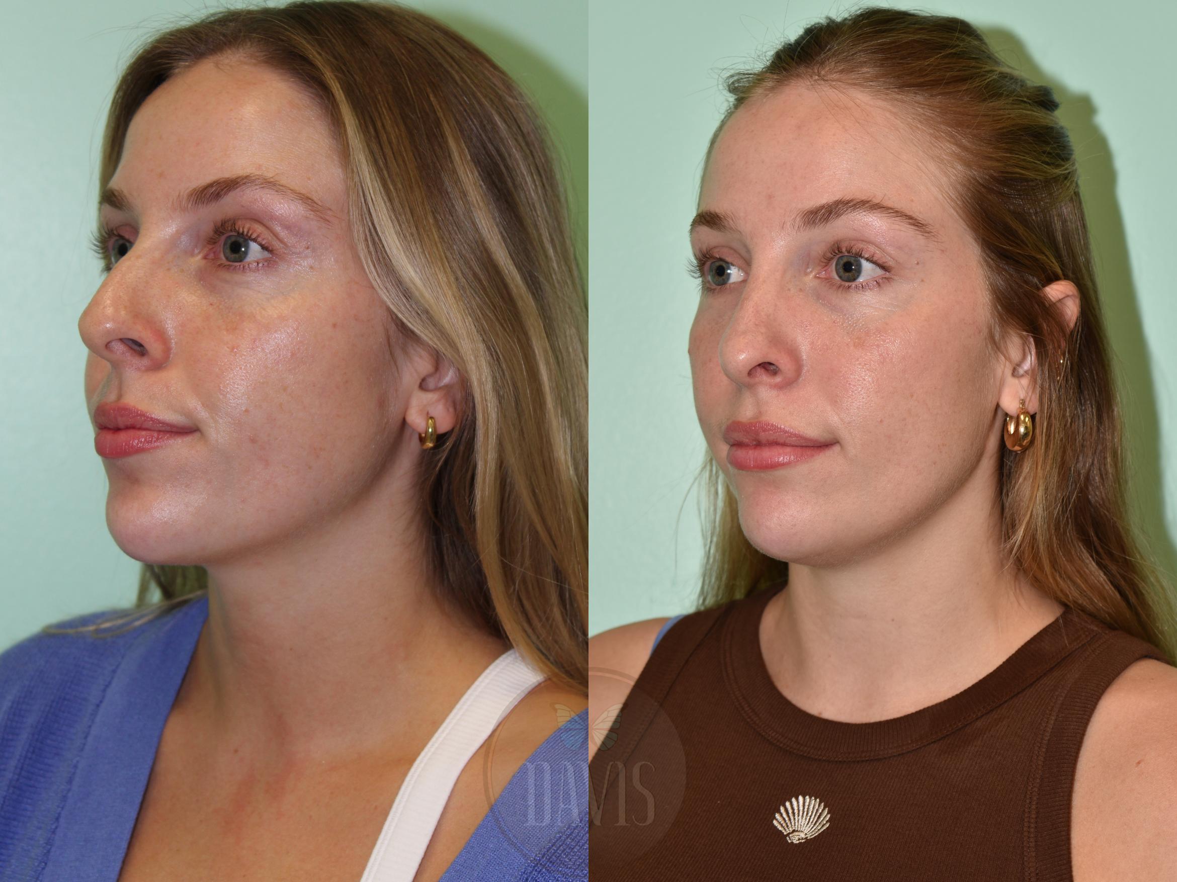 Before & After Female Rhinoplasty Case 1165 Left Side View in Tampa, FL