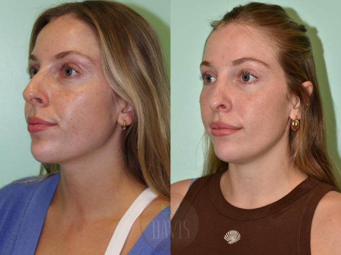 Before & After Female Rhinoplasty Case 1165 Left Side View in Tampa, FL