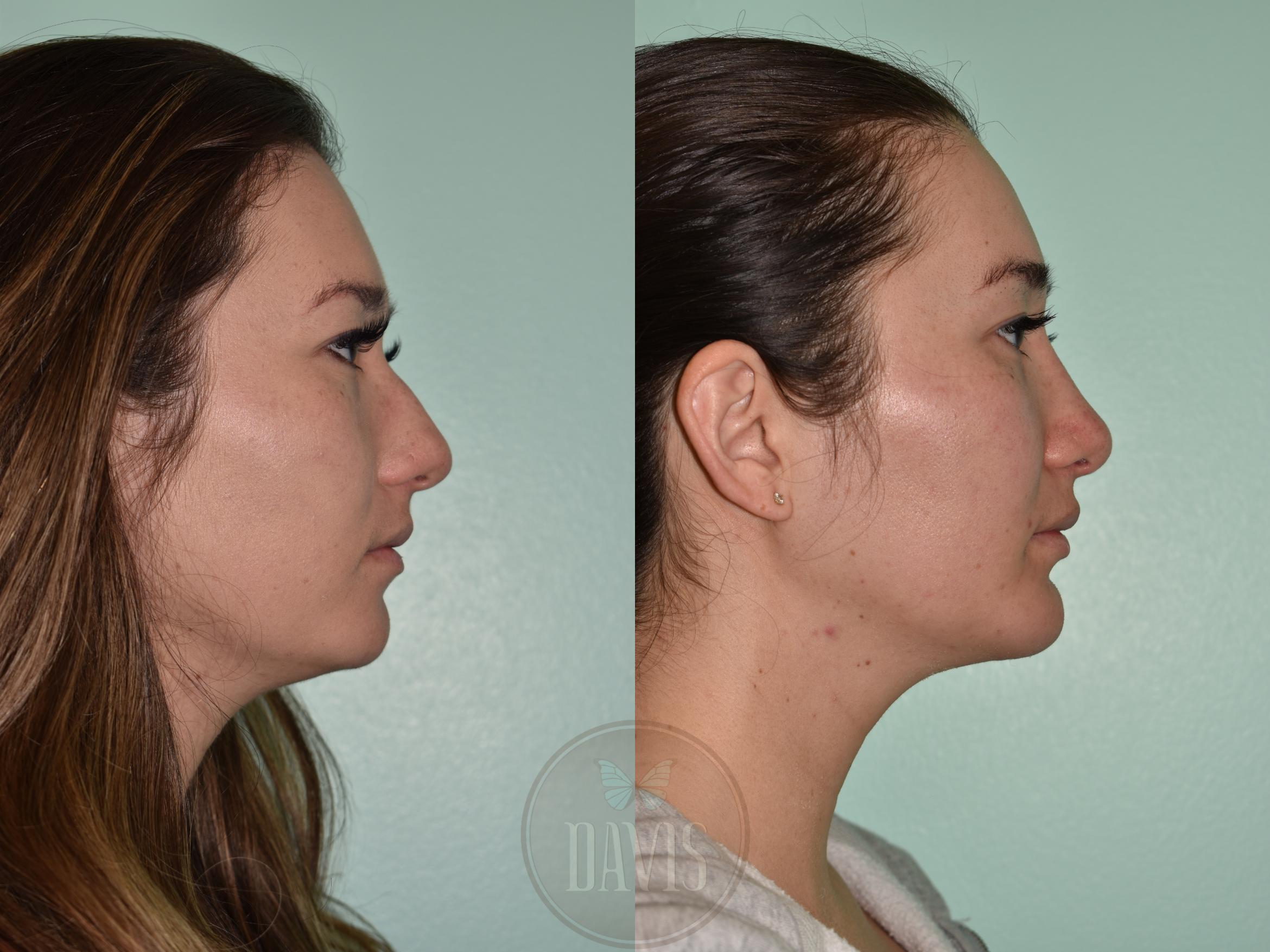 Before & After Female Rhinoplasty Case 1167 Front View in Tampa, FL
