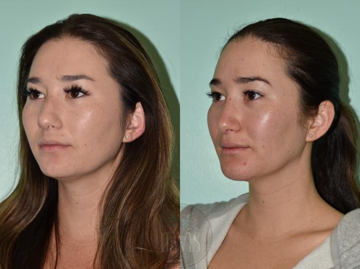 Before & After Female Rhinoplasty Case 1167 Left Oblique View in Tampa, FL