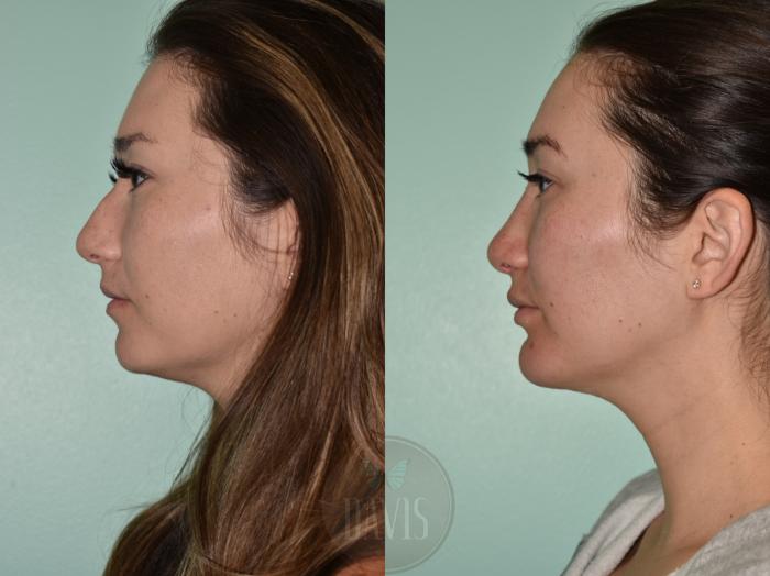 Before & After Chin Augmentation Case 1167 Left Side View in Tampa, FL