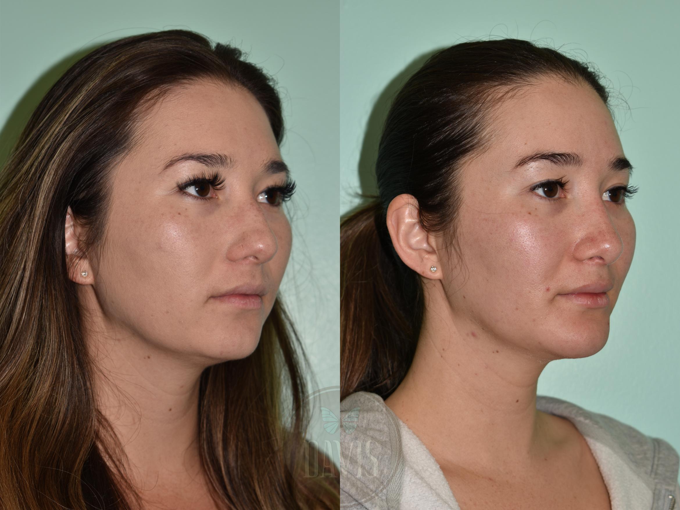 Before & After Female Rhinoplasty Case 1167 Right Side View in Tampa, FL