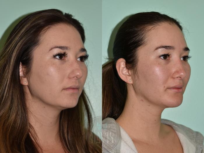 Before & After Female Rhinoplasty Case 1167 Right Side View in Tampa, FL