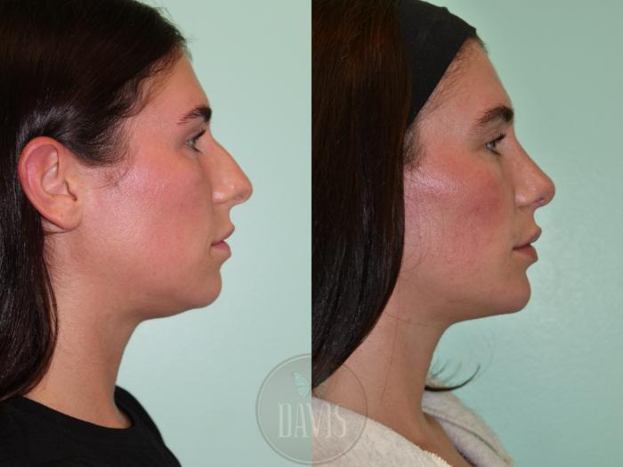 Before & After Female Rhinoplasty Case 1169 Front View in Tampa, FL