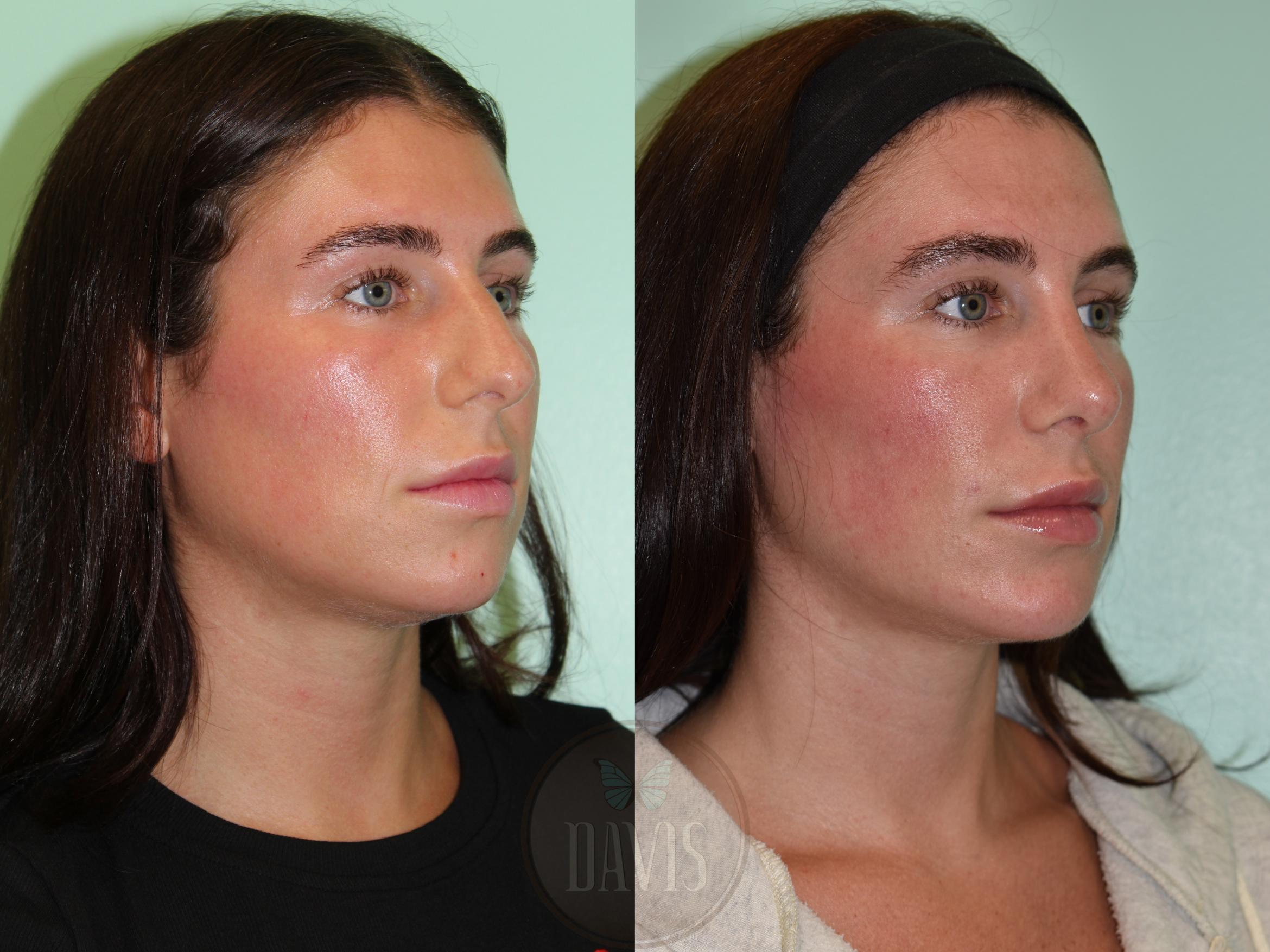 Before & After Female Rhinoplasty Case 1169 Left Oblique View in Tampa, FL