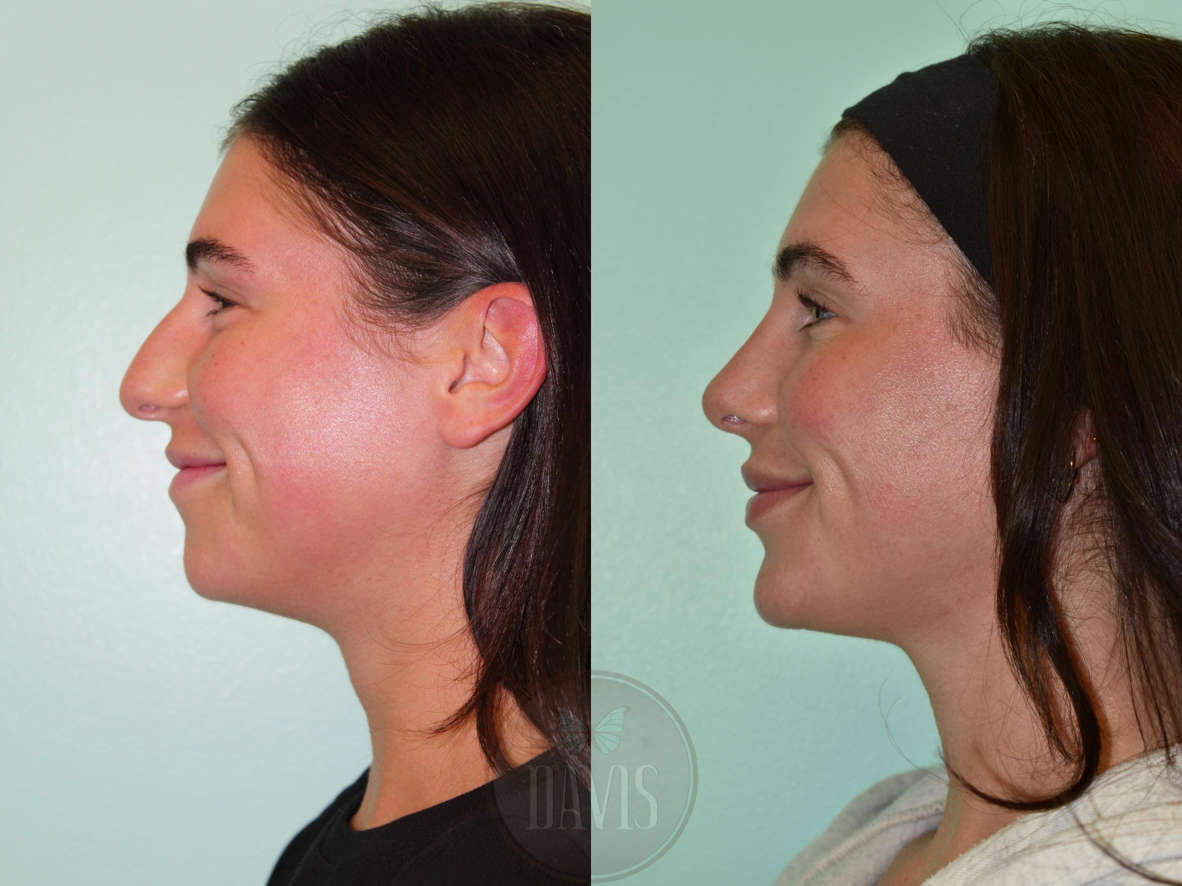 Before & After Female Rhinoplasty Case 1169 Left Side View in Tampa, FL