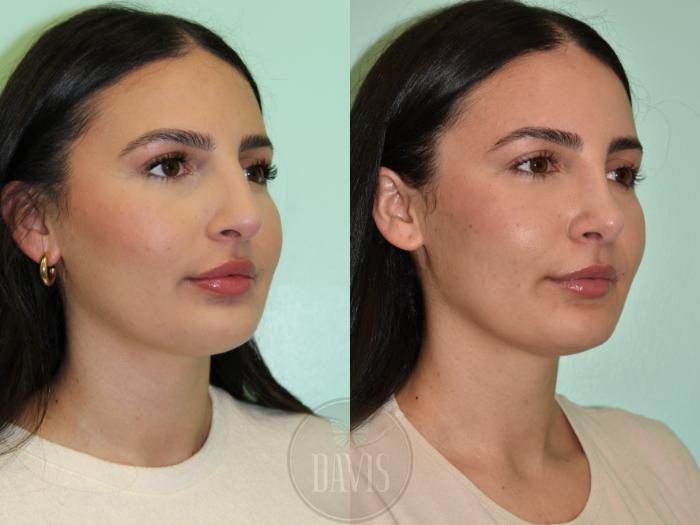 Before & After Female Rhinoplasty Case 1170 Front View in Tampa, FL