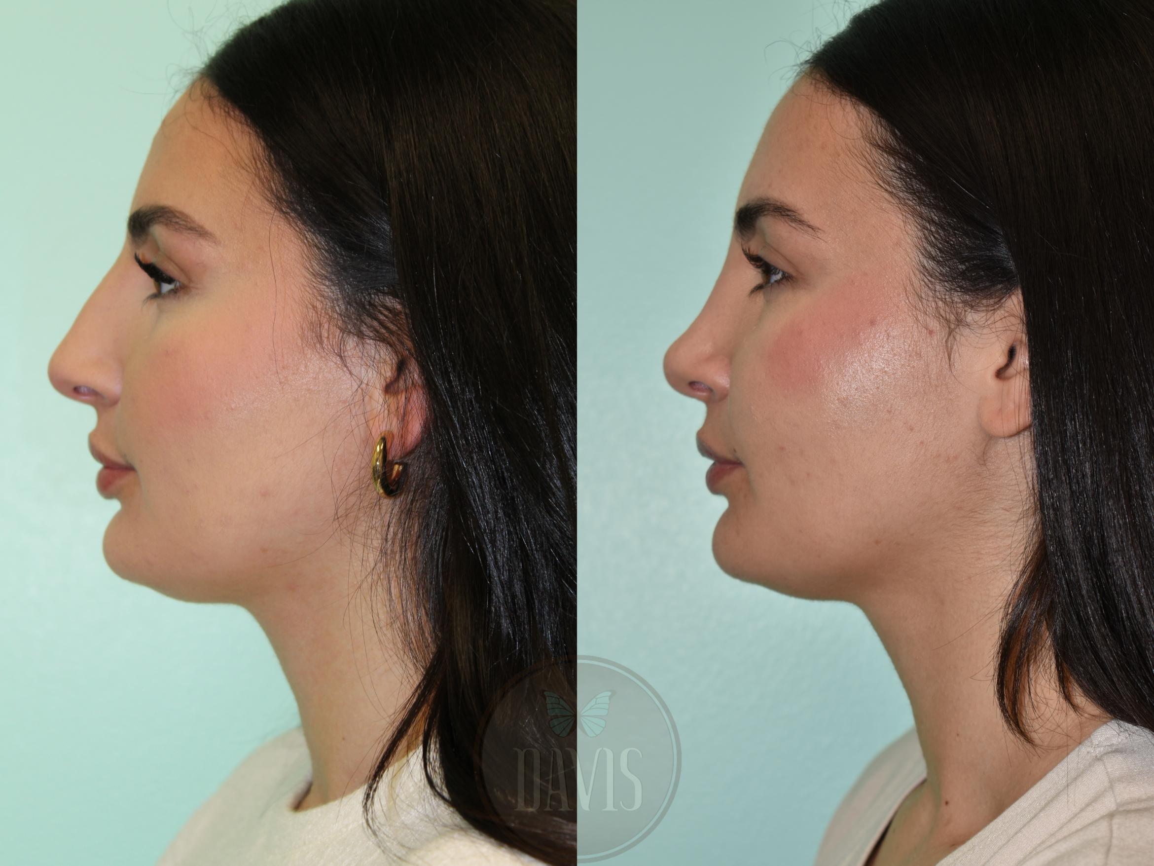 Before & After Female Rhinoplasty Case 1170 Left Oblique View in Tampa, FL