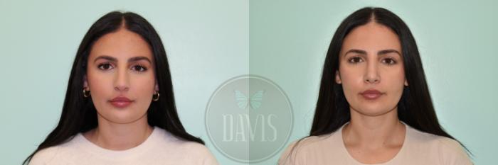 Before & After Female Rhinoplasty Case 1170 Left Side View in Tampa, FL