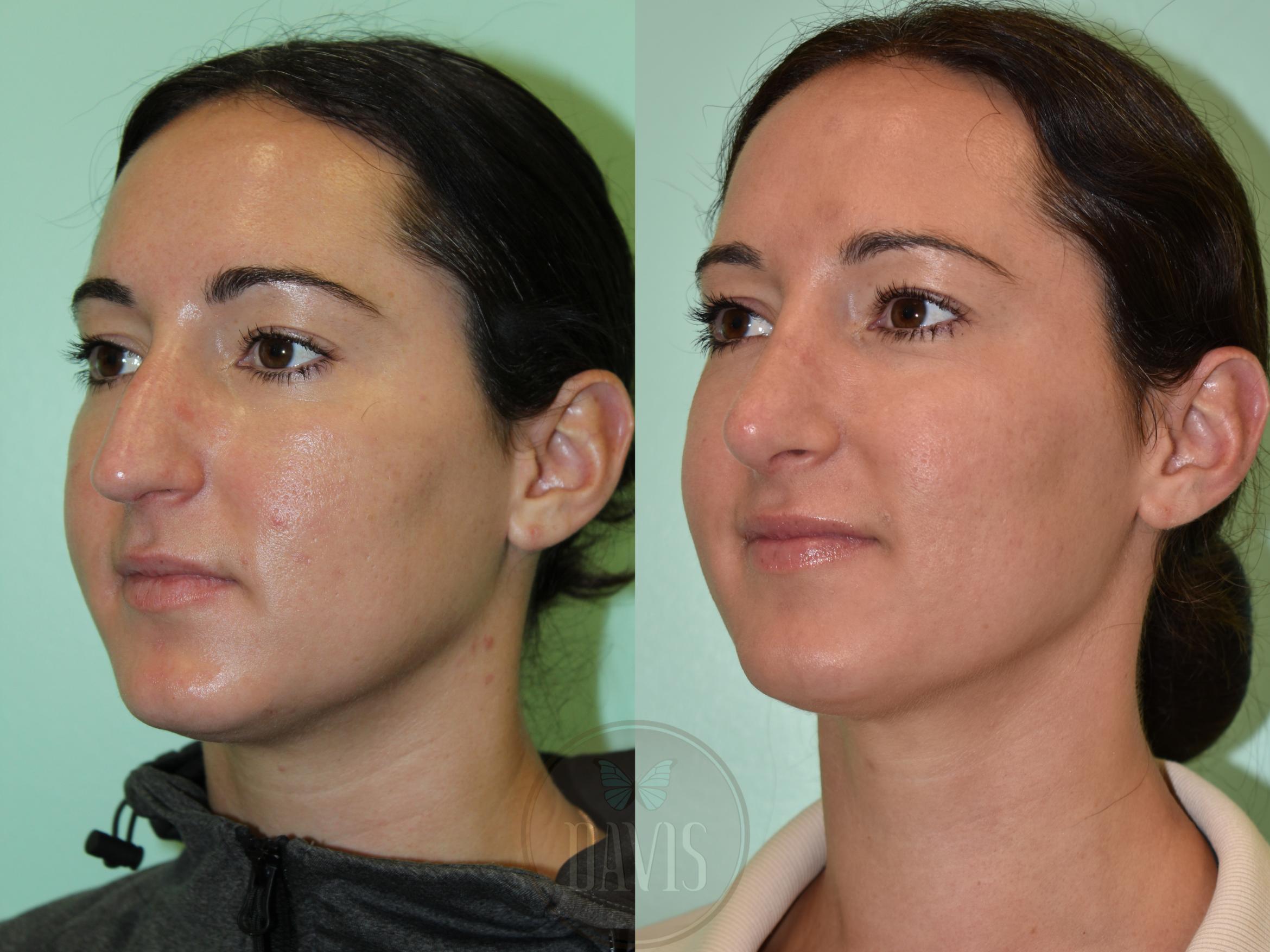 Before & After Female Rhinoplasty Case 1171 Left Oblique View in Tampa, FL