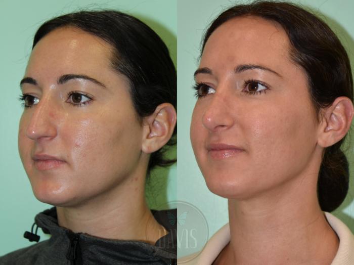 Before & After Female Rhinoplasty Case 1171 Left Oblique View in Tampa, FL