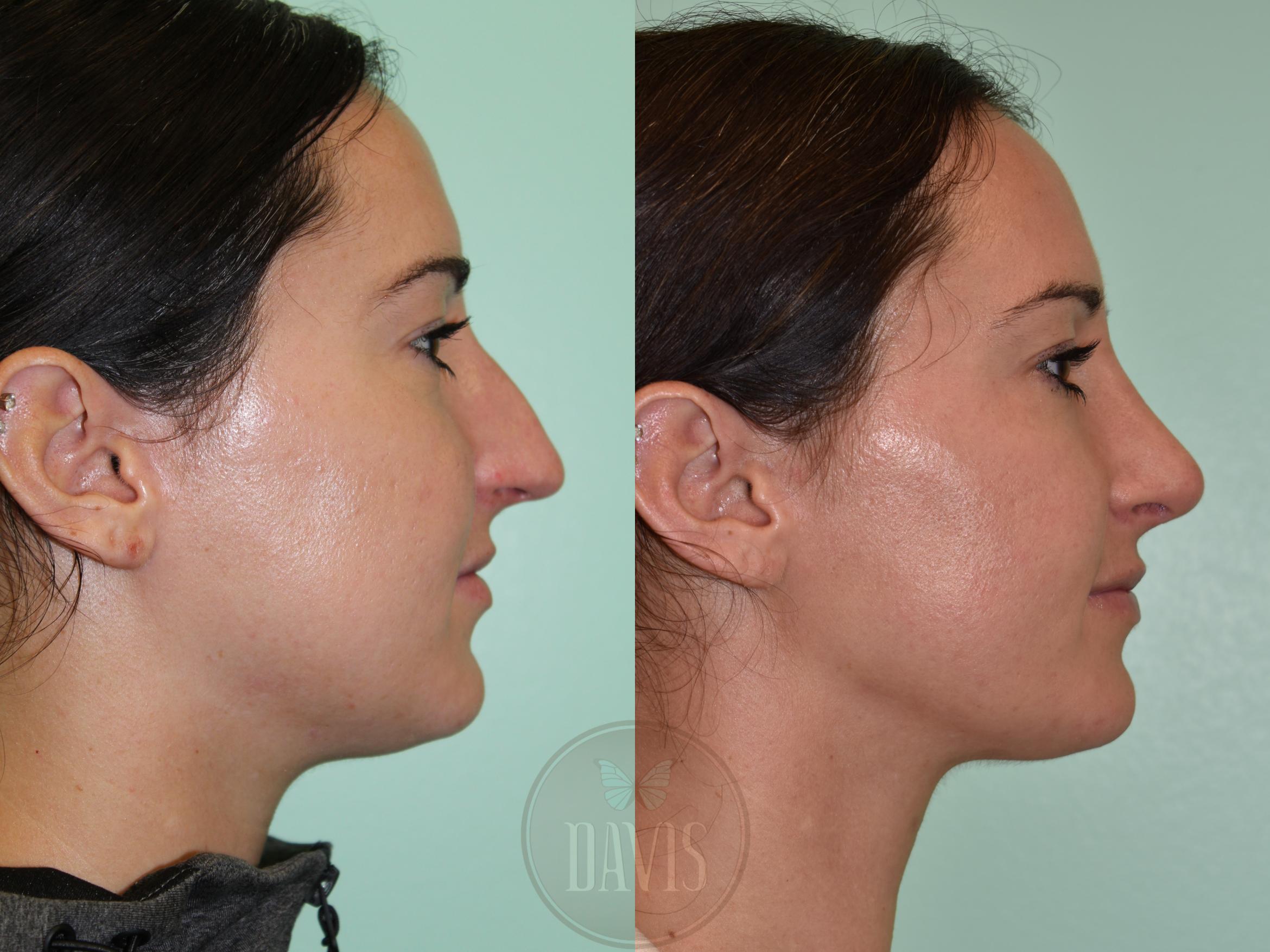 Before & After Female Rhinoplasty Case 1171 Left Side View in Tampa, FL
