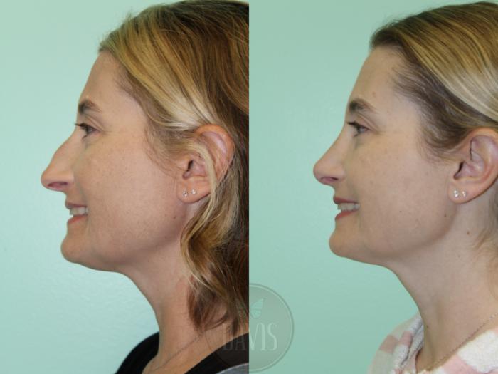 Before & After Female Rhinoplasty Case 1173 Front View in Tampa, FL