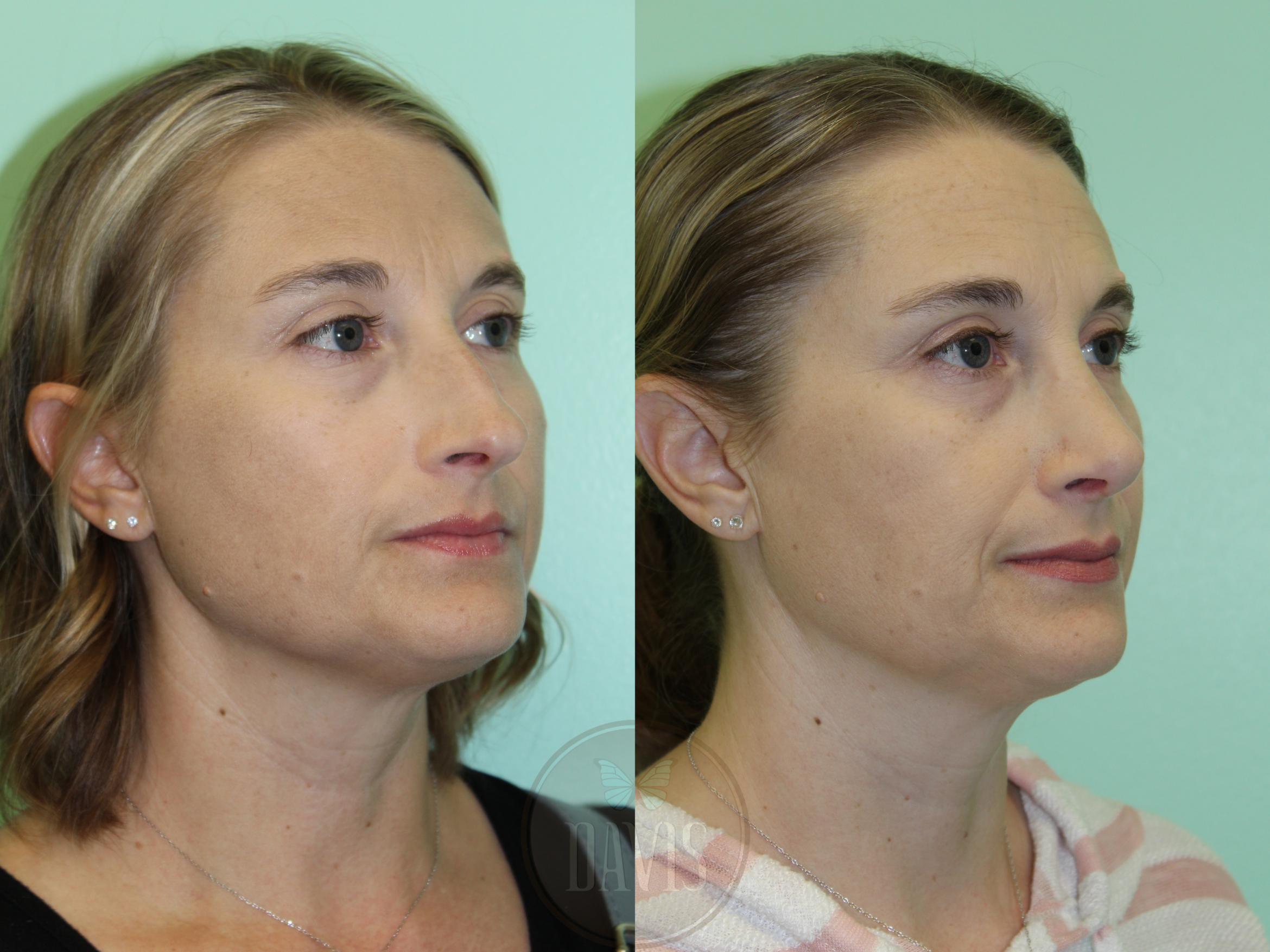 Before & After Female Rhinoplasty Case 1173 Left Oblique View in Tampa, FL