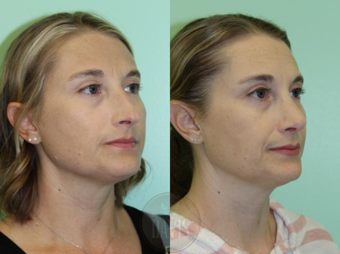 Before & After Female Rhinoplasty Case 1173 Left Oblique View in Tampa, FL