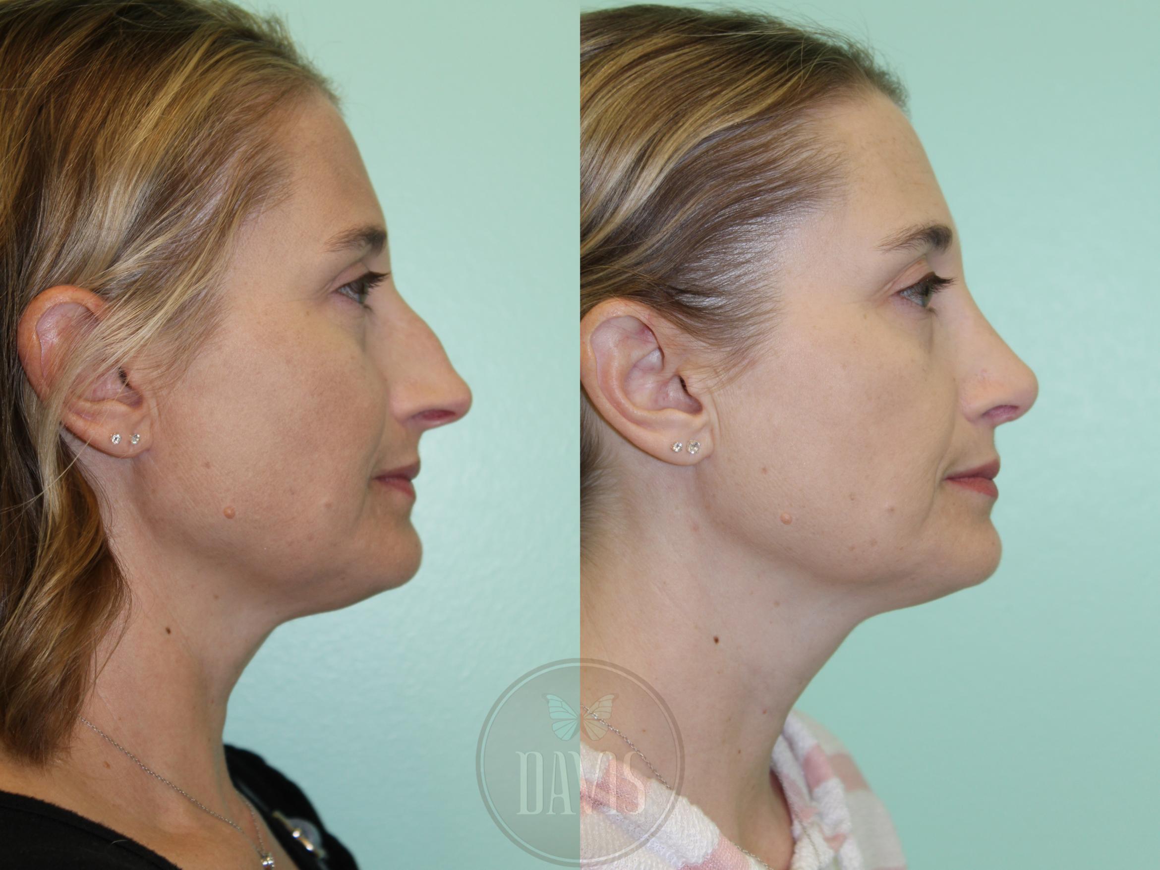 Before & After Female Rhinoplasty Case 1173 Left Side View in Tampa, FL