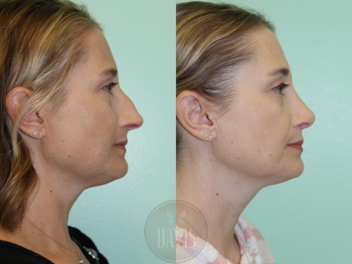 Before & After Female Rhinoplasty Case 1173 Left Side View in Tampa, FL