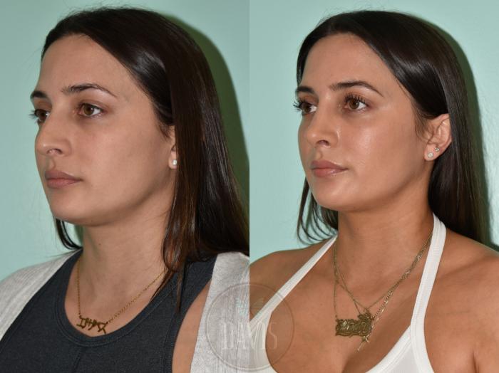Before & After Female Rhinoplasty Case 1174 Front View in Tampa, FL