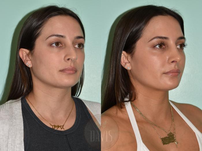 Before & After Female Rhinoplasty Case 1174 Left Oblique View in Tampa, FL